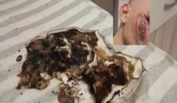 Τραυματισμός από μπαταρία κινητού